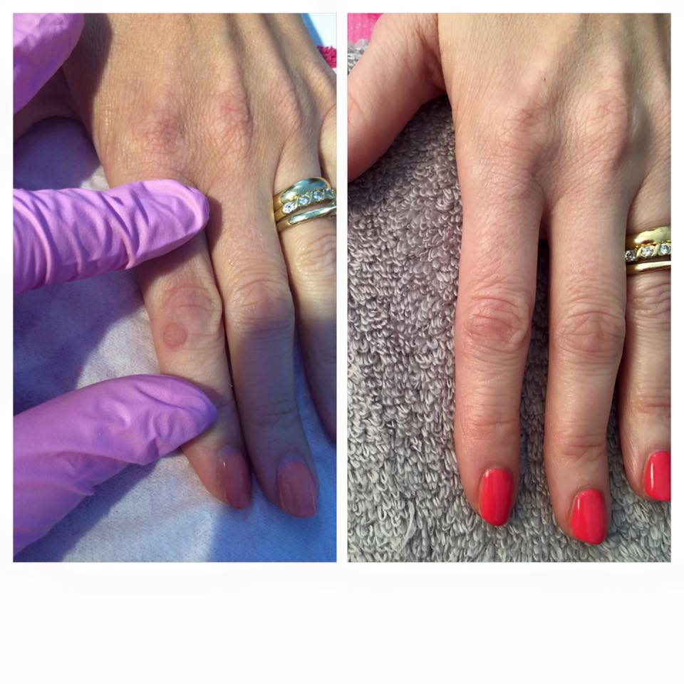 Wart before and after cryotherapy treatment — Victoria Joy Beauty